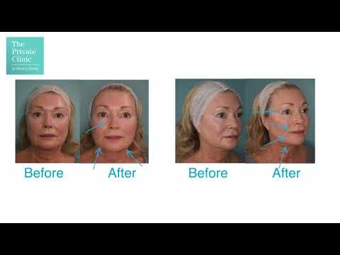 Dermal Filler for Nose to Mouth Lines Treatment without surgery