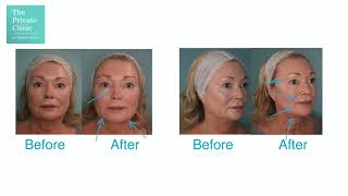 Dermal Filler for Nose to Mouth Lines, Liquid facelift - Facelift without surgery