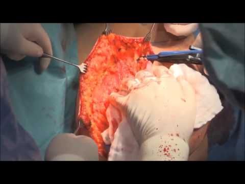 marClamp® Cut IQ and maXium® – Breast reconstruction