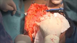 marClamp® Cut IQ and maXium® | Breast reconstruction