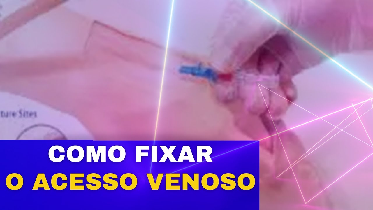 Como fazer a fixação da Punção VENOSA Periférica com Jelco  ou scalp