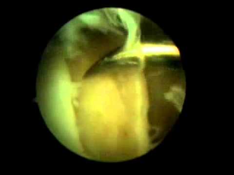 Von dem Schmerz nach dem Training Ellenbogen Osteochondrose der Kammer im Bein und im Hoden