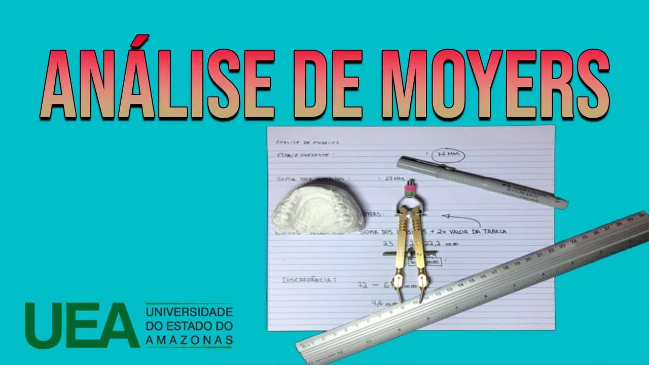 Watch Now Análise da Dentição Mista pelo Método de Moyers Análise da Dentição Mista pelo Método de Moyers