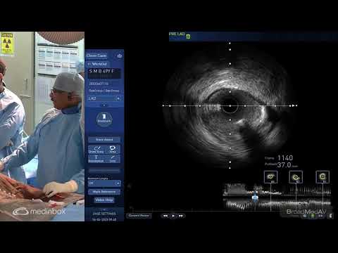 PCI Of LAD Under IVUS Guidance