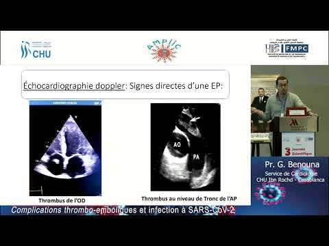 Complications thrombo-emboliques et infection à SARS-CoV-2 (Pr. G. Bennouna)