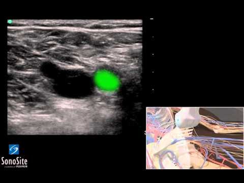 3D Lehrvideo: Ultraschalluntersuchung für tiefe Venenthrombose -  SonoSite Ultraschall