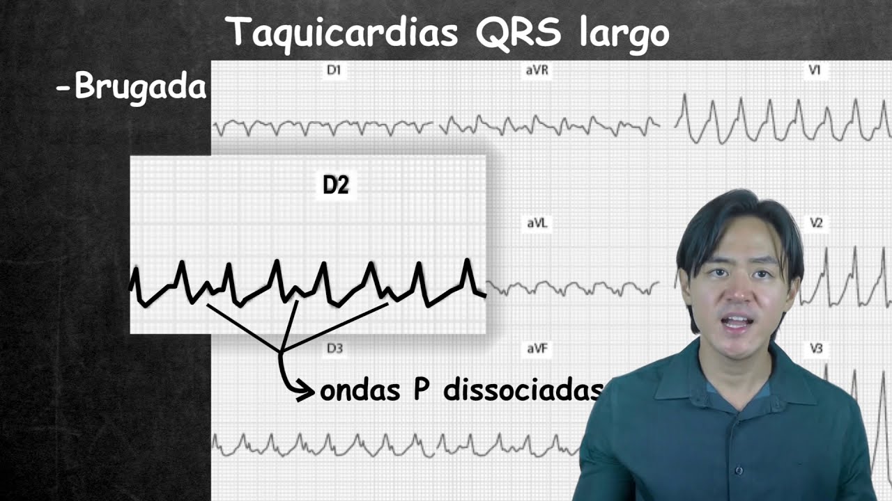 Eletrocardiograma taquicardia QRS largo