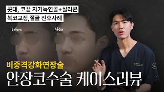 비중격강화연장술 안장코수술 케이스 리뷰 [늑떼선생김현주의 수술사례 및 케이스리뷰]