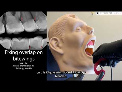 Fixing Overlap on Bitewings