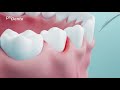 Https Www Prodente De Fileadmin Redakteure Videos Kurzfilm Parodontitis