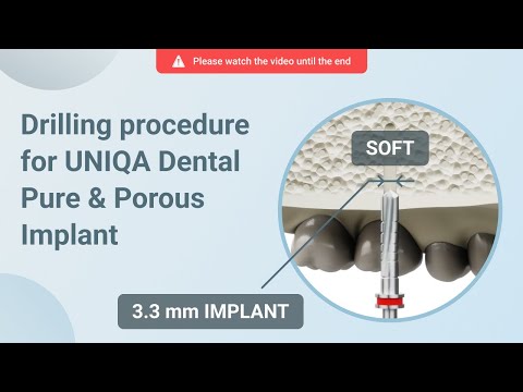 Drilling procedure for UNIQA Dental Pure & Porous Implant UH8 UV11 [ 3.3 mm | D4 bone density ]