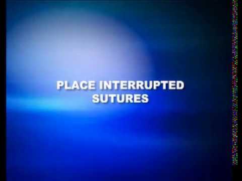 How to insert an interrupted suture