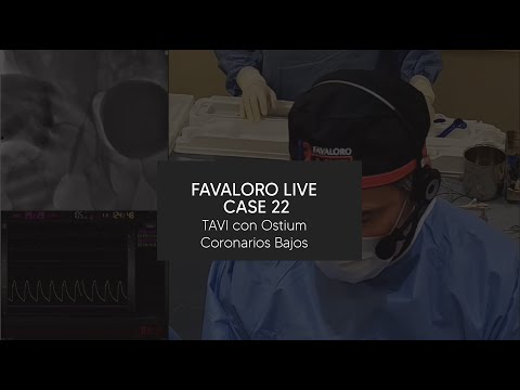 Favaloro Live Case N° 22 - TAVI con Ostium Coronarios Bajos
