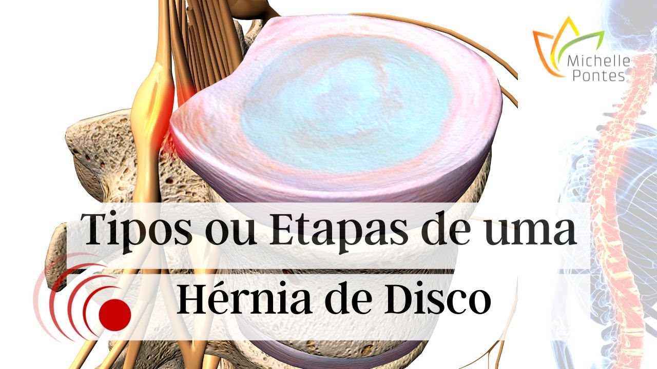Tipos de Hérnia de Disco e Como Solucionar