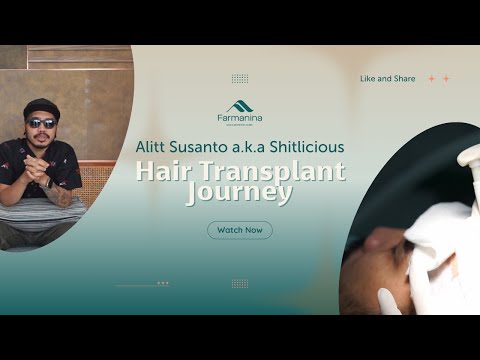 Alitt Susanto a.k.a shitlicious Hair Transplant Journey
