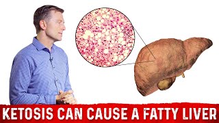 A Ketogenic Diet Can Cause a Fatty Liver