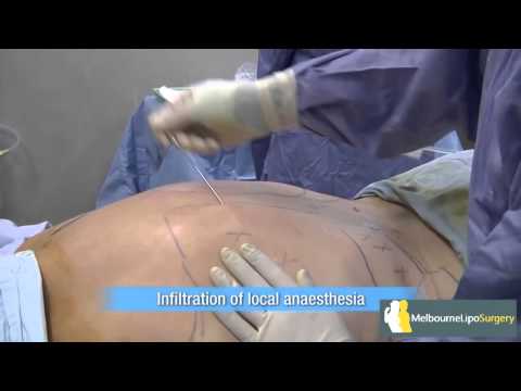 download lagu mp3 mp4 Liposuction Melbourne, download lagu Liposuction Melbourne gratis, unduh video klip Liposuction Melbourne