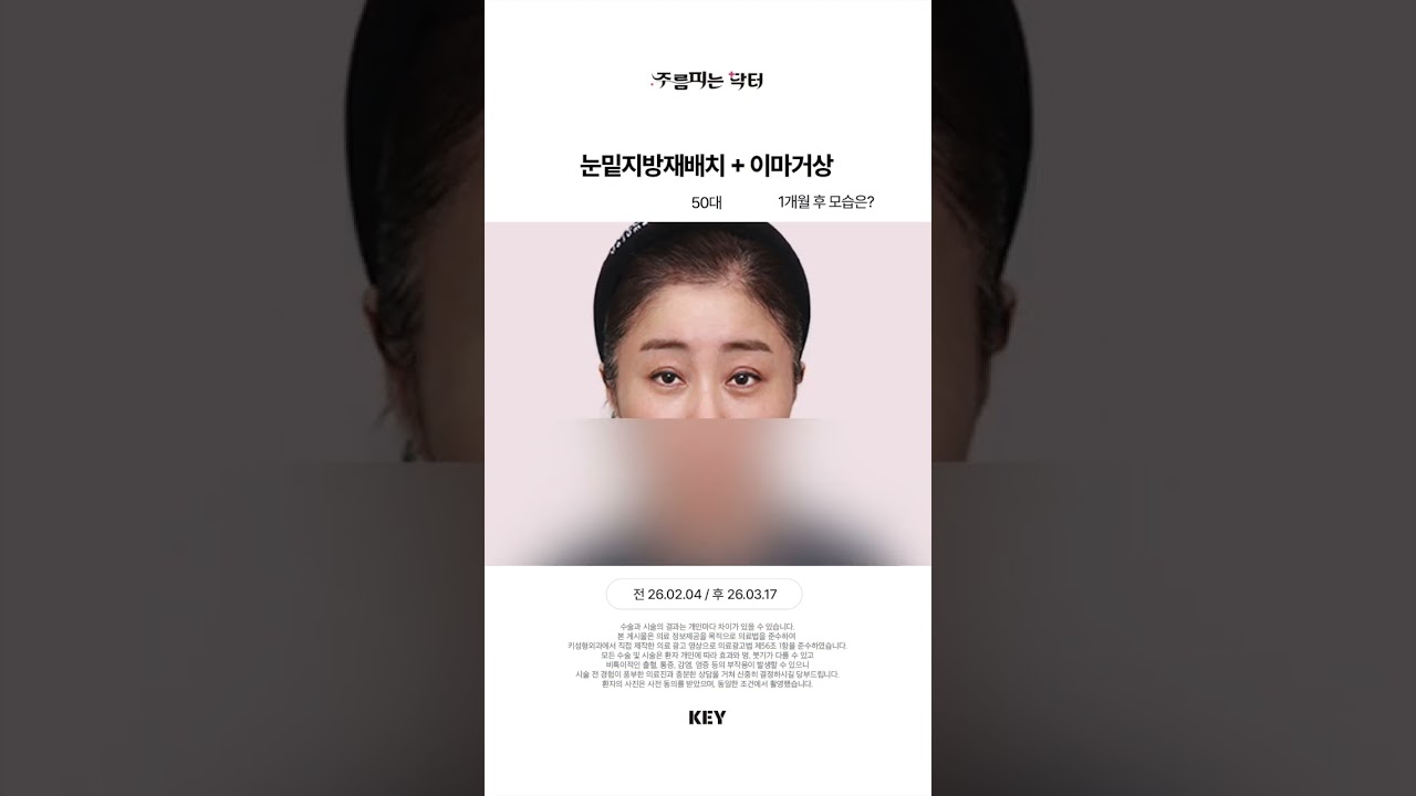 50대의 눈밑지방재배치, 이마거상