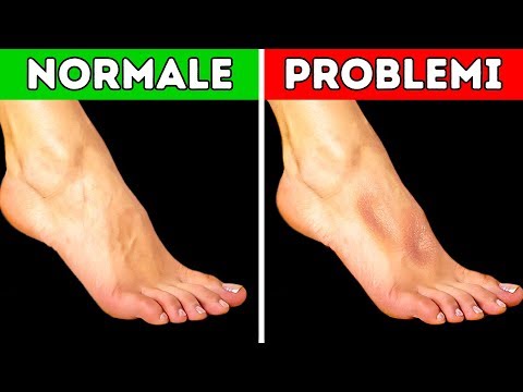 Il perossido candeggia la pelle e Lotta contro pigmentazione su una faccia in cosmetology