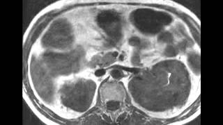 Erdheim chester syndrome