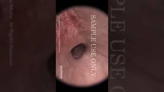 Download lagu Cara melihat kedalaman rahim! 😱 #kesehatanwanita #pemeriksaanrahim #hiteroskopi #tipspromil mp3 Download lagu Cara melihat kedalaman rahim! 😱 #kesehatanwanita #pemeriksaanrahim #hiteroskopi #tipspromil mp3