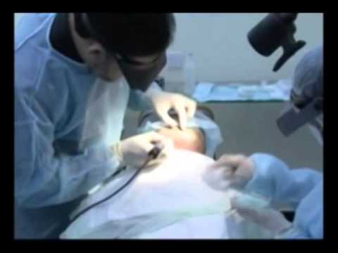 Follicular Unit Extraction (FUE) Melbourne - Dr. M. Alam