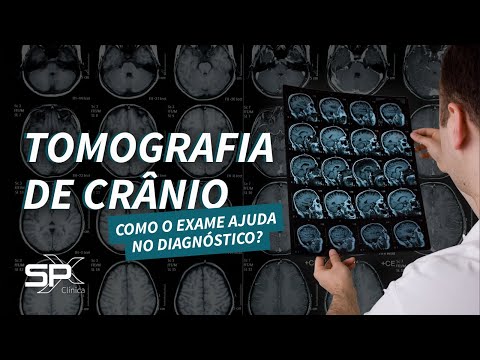 Tomografia de Crânio: como o exame ajuda no Diagnóstico de Doenças Neurológicas? 🤔