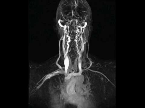 Entfernen von akuten Schmerzen in Osteochondrose Klicken Gelenke Kalzium