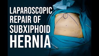 Laparoscopic Repair of Subxiphoid Incisional Hernia in High-Risk Patient | Dr. Samrat Jankar