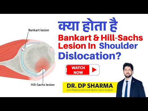 What is Bankart & Hill-Sachs lesion? Shoulder Dislocation Treatment In Delhi-NCR - Dr DP Sharma