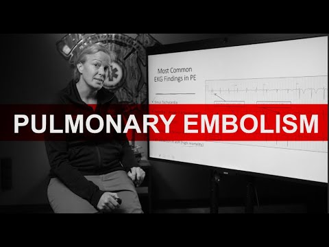 Pulmonary Embolism EKG