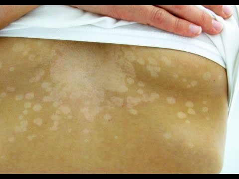 Namamaga lymph nodes sa mawala ang timbang Kung paano magluto oatmeal pagkain
