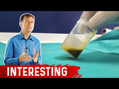 The 12 Signs that Your Gallbladder is in DANGER