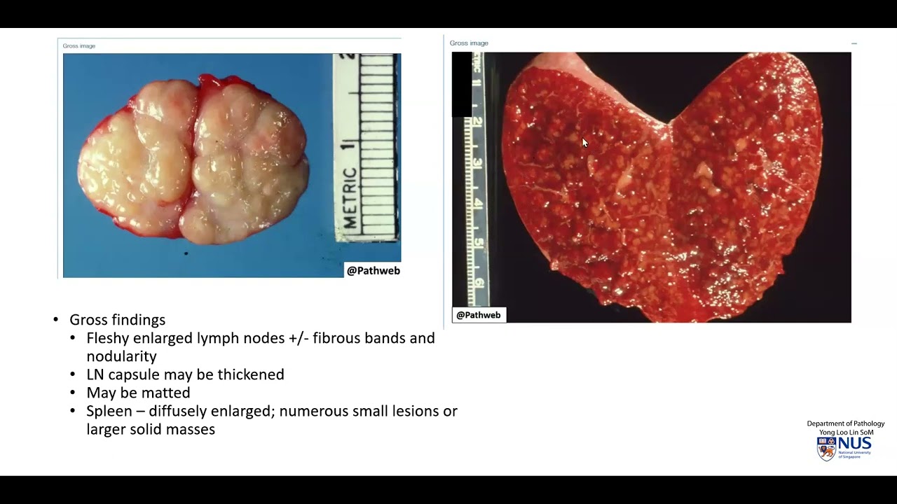 Lymph node and Spleen: Hodgkin lymphoma (Gross pathology)