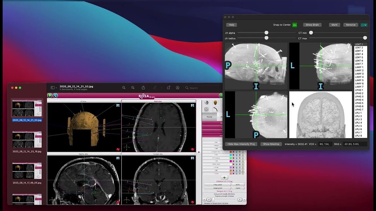 MNE-Python Intracranial Electrode Location Tutorial