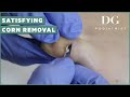 Satisfying corn removal on pinky toe | The Foot Scraper: DG Podiatrist