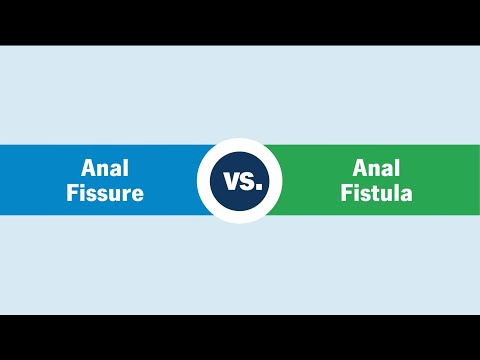 Anal Fissure vs. Fistula
