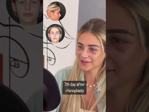 7th Day After | Rhinoplasty Cast Removal in Antalya/Turkey
