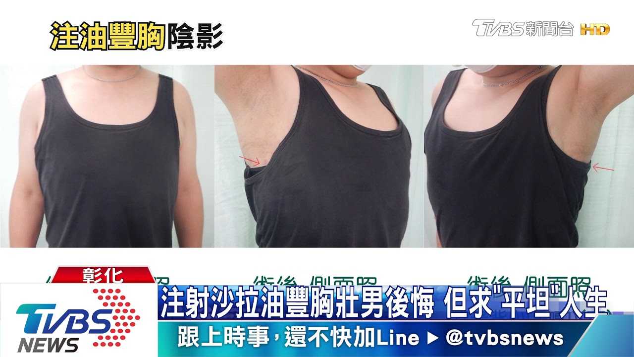 注射沙拉油豐胸壯男後悔 但求「平坦」人生