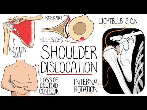 Shoulder Dislocation Explained Clearly (Glenohumeral Joint Dislocation)
