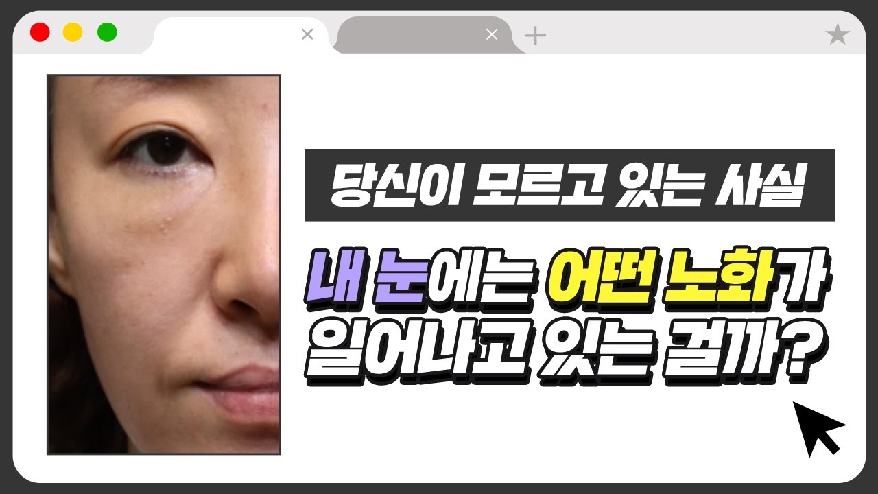 나도 모르는 사이 내 눈에 일어나는 일들? 눈밑주름, 눈밑처짐, 다크서클, 눈밑지방 해결 방법은?