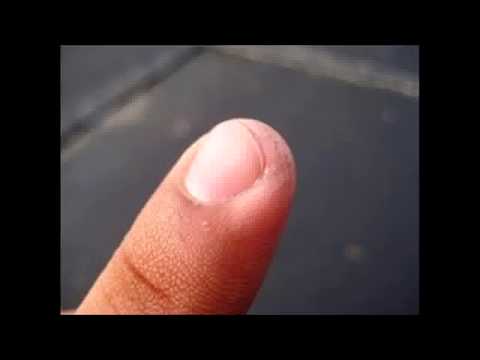 Kung paano ligtas na tanggalin ang kuko halamang-singaw Itigil ang halamang-singaw paggamot sa panahon ng paggagatas