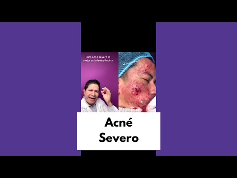 Caso de acné severo 😮