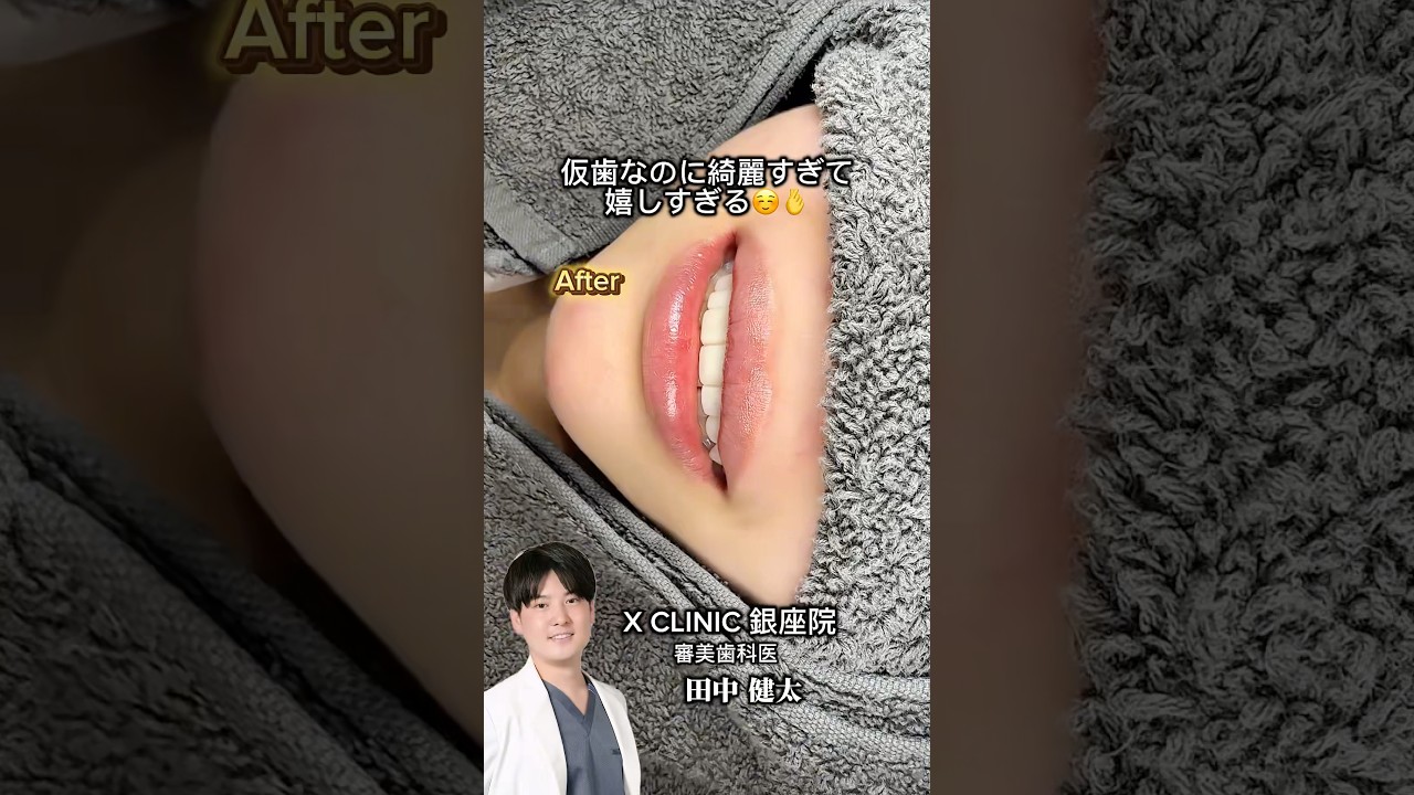 即日仮歯でお悩みを解決します☺️🦷 #審美歯科 #セラミック #歯並び