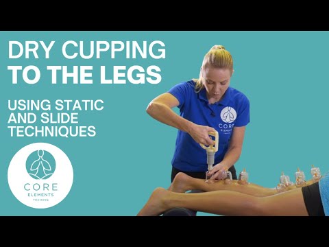 Demonstration of Dry Cupping to the legs using static and slide techniques