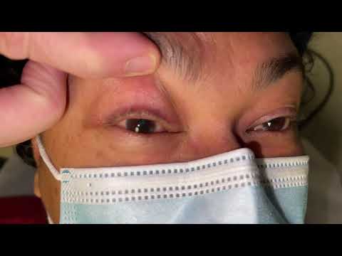 Dix-Hallpike test of left posterior canal BPPV, before and after Epley maneuver