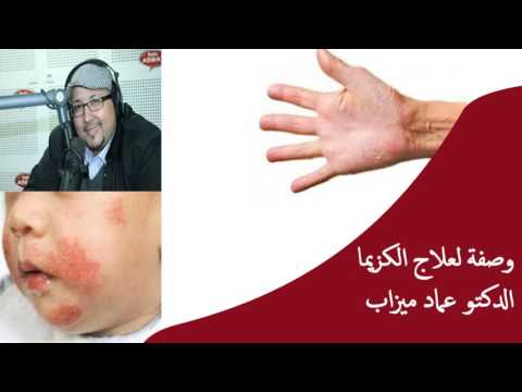 وصفة لعلاج الكزيما والفطريات  / الدكتور عماد ميزاب