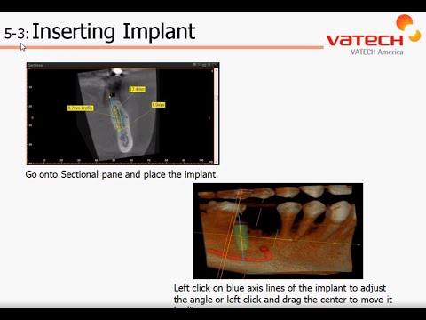 Implant Placement