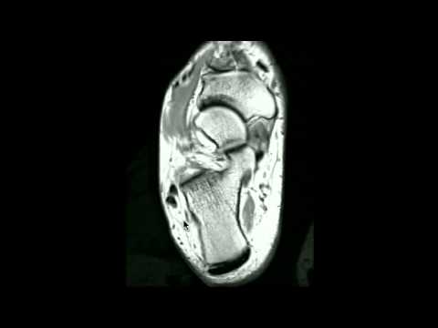 La formazione in un simulatore per osteocondrosi Rafano con artrosi dellarticolazione della spalla