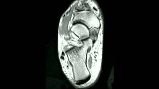 MRI Ankle